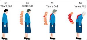 women are more likely to develop osteoporosis then men 300x140