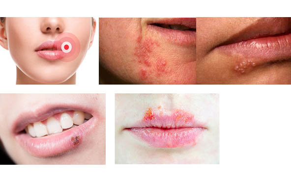 Cold sore symptoms and cold sore stages