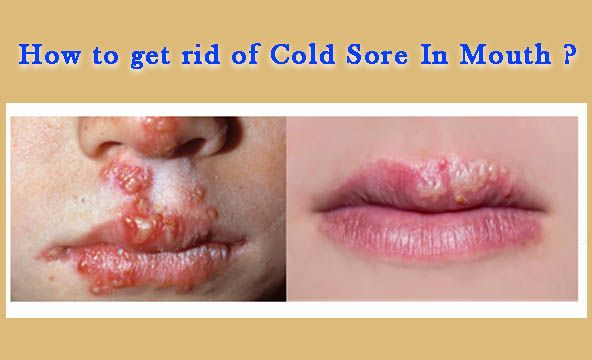 How to get rid of Cold Sore In Mouth
