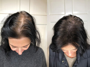 hair growth medicospace