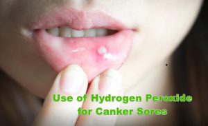 Use of Hydrogen Peroxide for Canker Sores