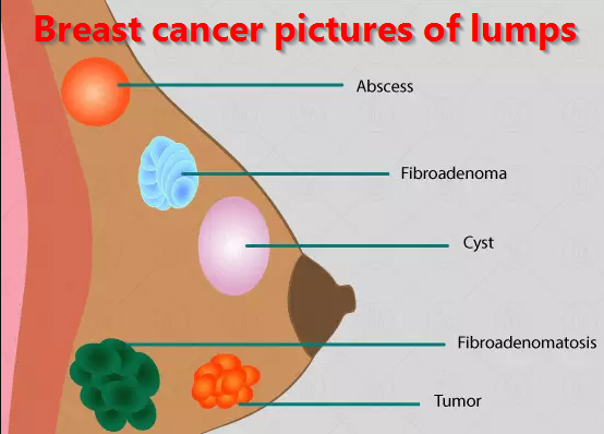 breast cancer pictures of lumps