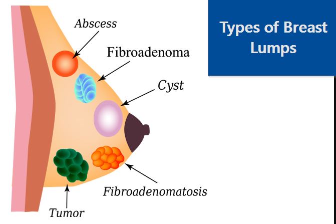 Types of Breast Lumps