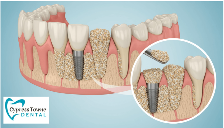 Dental Bone Graft